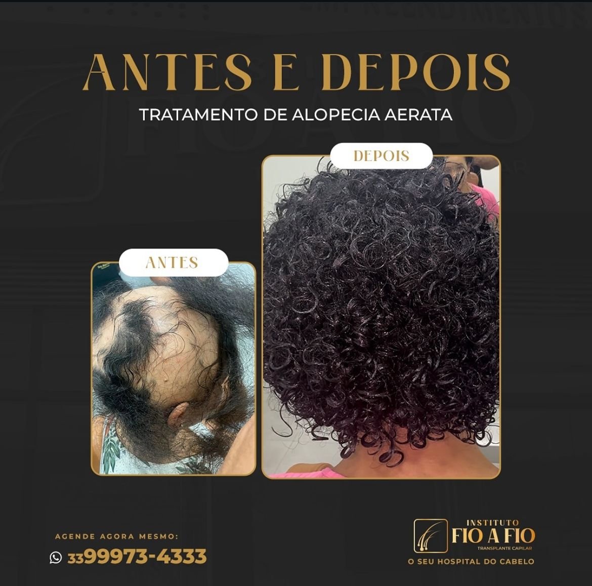 Tratamento de Alopecia aerata